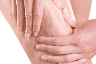 Prof. Dr. Karacalar’dan selülit uyarısı: Portakal kabuğu görüntüsü basit sorun değil!